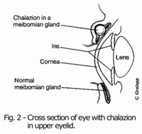 Chalazion-in-Meibomian-Gland